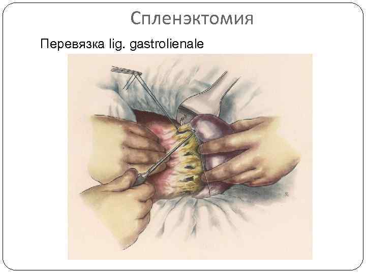 Спленэктомия Перевязка lig. gastrolienale 