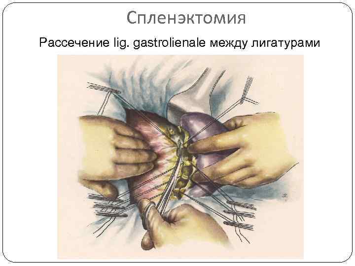 Спленэктомия Рассечение lig. gastrolienale между лигатурами 