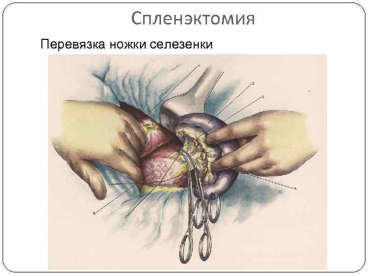 Спленэктомия Перевязка ножки селезенки 