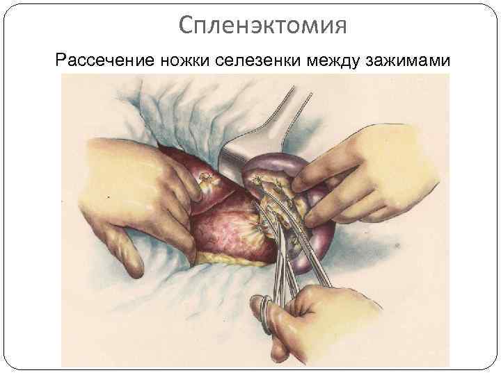 Спленэктомия Рассечение ножки селезенки между зажимами 