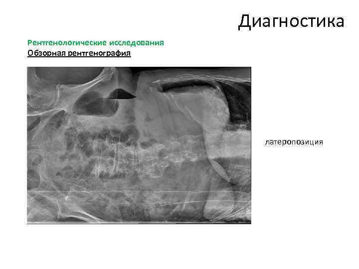 Полость свободно. Латеропозиция брюшной полости. Латеропозиция рентген брюшной полости. Латерография брюшной полости рентген. Рентгенография брюшной полости в латеропозиции.