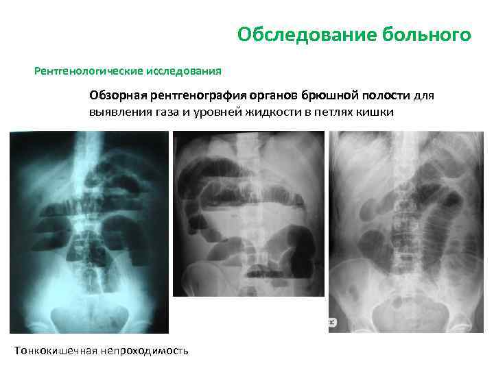 Пневматизация петель кишечника