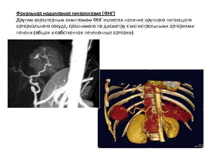Фокальная нодулярная гиперплазия (ФНГ) Другим характерным симптомом ФНГ является наличие крупного питающего артериального сосуда,