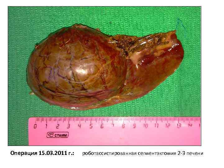 Операция 15. 03. 2011 г. : роботассистированная сегментэктомия 2 -3 печени 