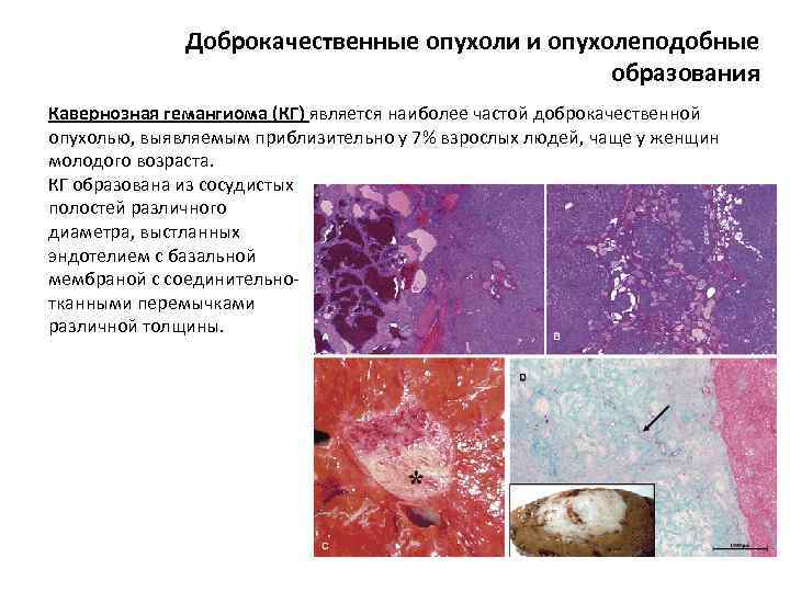 Доброкачественные опухоли и опухолеподобные образования Кавернозная гемангиома (КГ) является наиболее частой доброкачественной опухолью, выявляемым