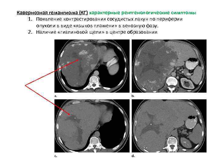 Кавернозная гемангиома (КГ) характерные рентгенологические симптомы 1. Появление контрастирования сосудистых лакун по периферии опухоли