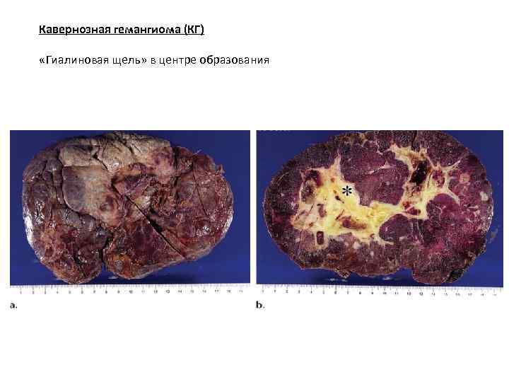 Кавернозная гемангиома (КГ) «Гиалиновая щель» в центре образования 