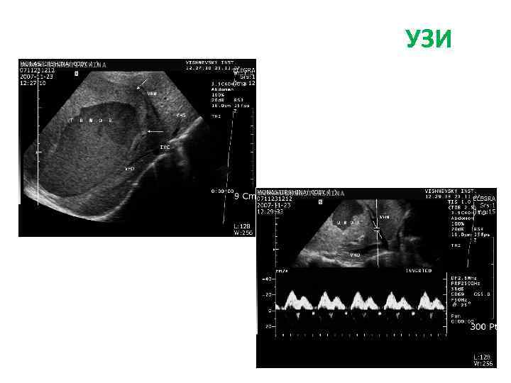 УЗИ + ДС сосудов брюшной полости УЗИ 