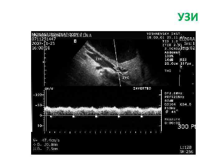 УЗИ + ДС сосудов брюшной полости УЗИ 