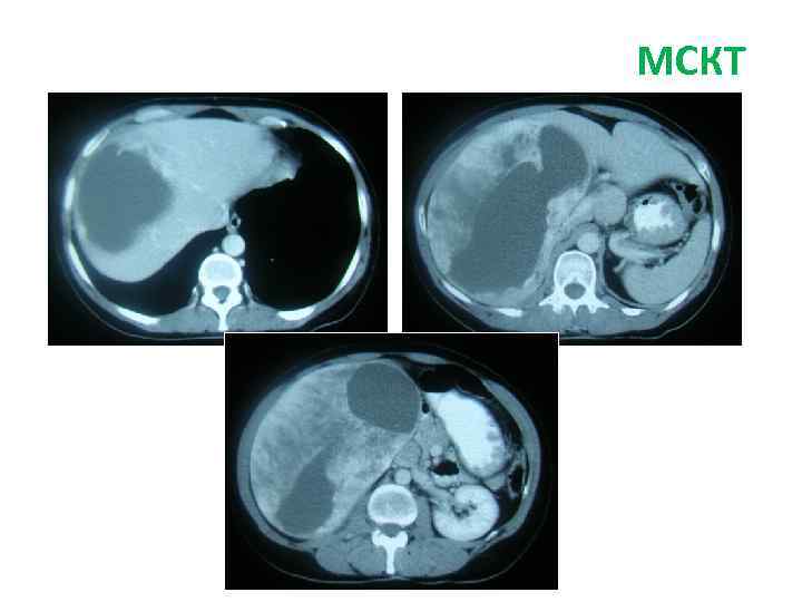 СКТ брюшной полости МСКТ 