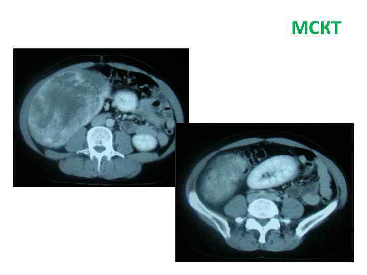 СКТ брюшной полости МСКТ 