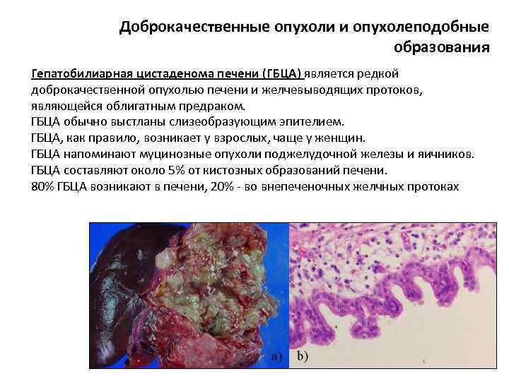 Доброкачественные опухоли и опухолеподобные образования Гепатобилиарная цистаденома печени (ГБЦА) является редкой доброкачественной опухолью печени