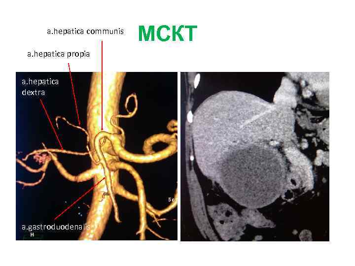 a. hepatica communis a. hepatica propia a. hepatica dextra a. gastroduodenalis МСКТ 
