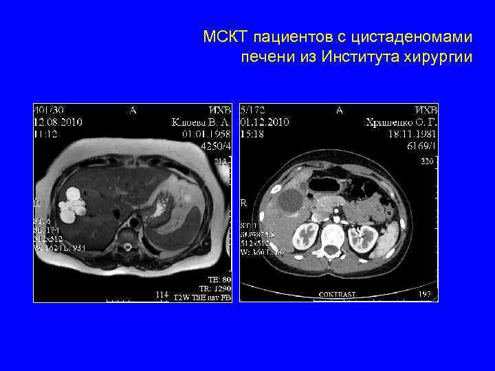 МСКТ пациентов с цистаденомами печени из Института хирургии 