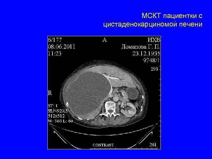 МСКТ пациентки с цистаденокарциномой печени 
