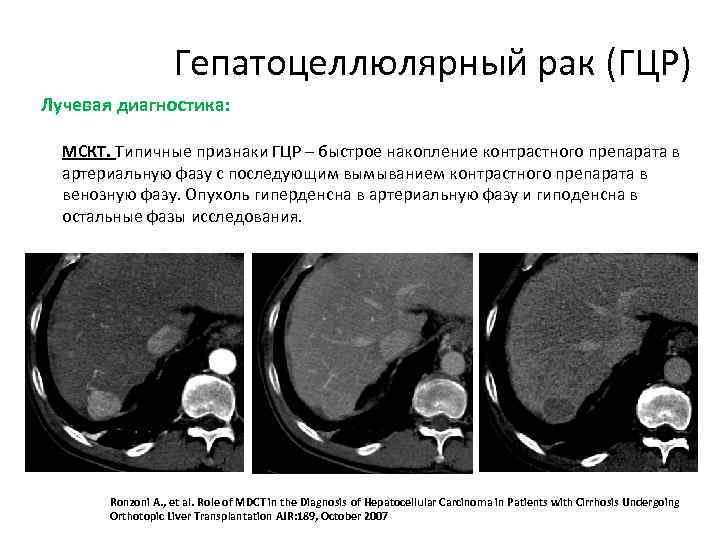 Гепатоцеллюлярный рак презентация