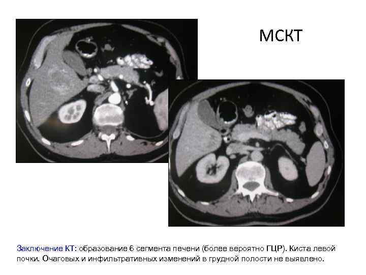 МСКТ Заключение КТ: образование 6 сегмента печени (более вероятно ГЦР). Киста левой почки. Очаговых