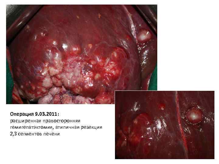 Операция 9. 03. 2011: расширенная правосторонняя гемигепатэктомия, атипичная резекция 2, 3 сегментов печени 