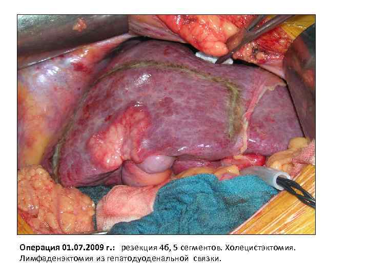 Операция 01. 07. 2009 г. : резекция 4 б, 5 сегментов. Холецистэктомия. Лимфаденэктомия из