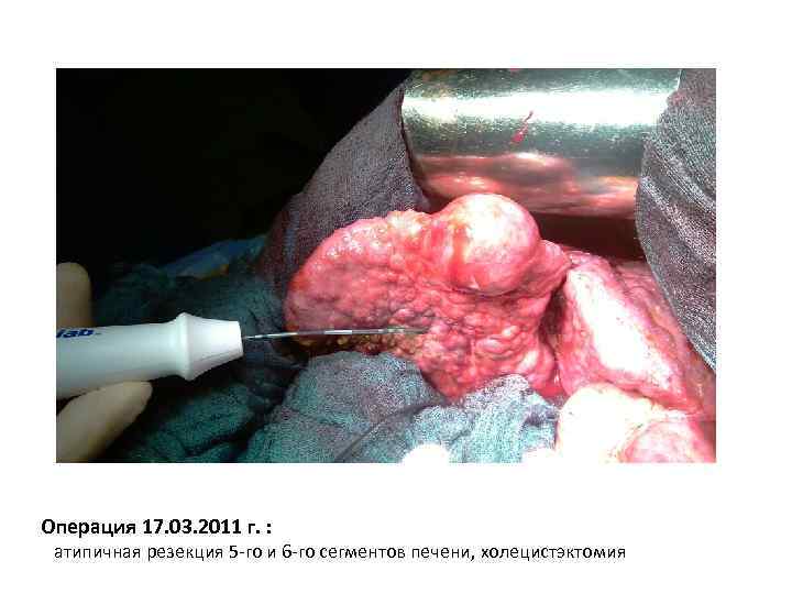 Операция 17. 03. 2011 г. : атипичная резекция 5 -го и 6 -го сегментов