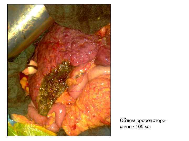 Объем кровопотери менее 100 мл 