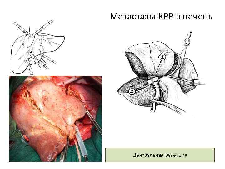 Метастазы КРР в печень Центральная резекция 