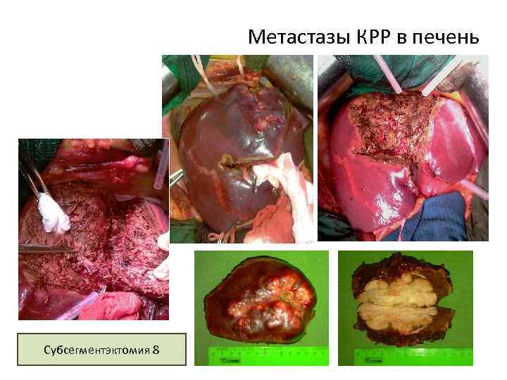 Метастазы КРР в печень Субсегментэктомия 8 