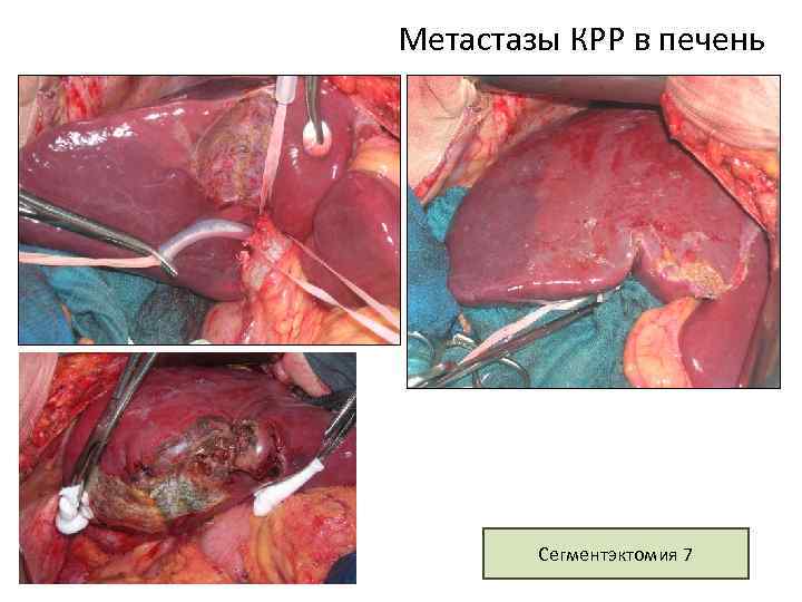 Метастазы КРР в печень Сегментэктомия 7 