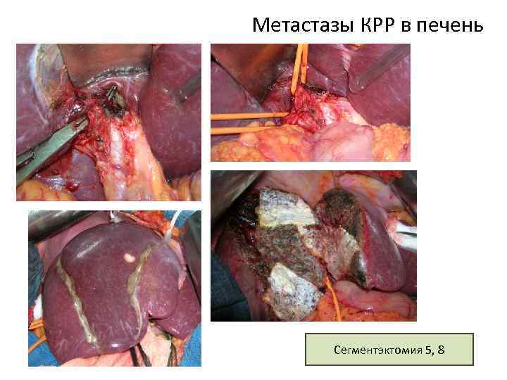 Метастазы КРР в печень Сегментэктомия 5, 8 