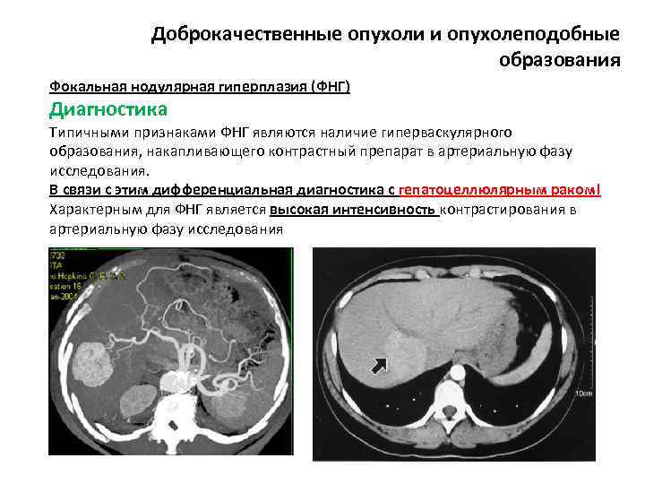 Доброкачественные опухоли и опухолеподобные образования Фокальная нодулярная гиперплазия (ФНГ) Диагностика Типичными признаками ФНГ являются
