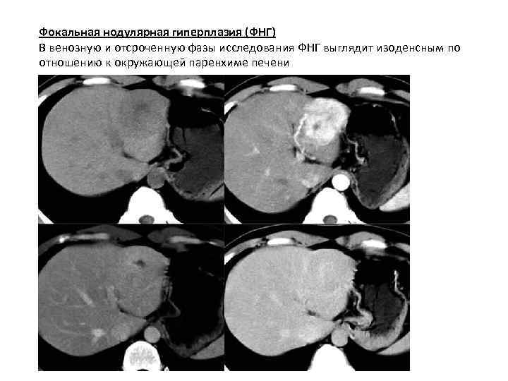 Фокальная нодулярная гиперплазия (ФНГ) В венозную и отсроченную фазы исследования ФНГ выглядит изоденсным по