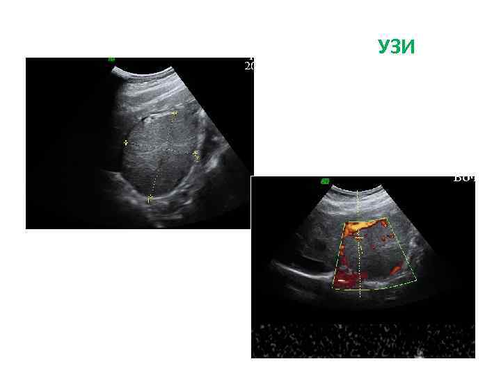 УЗИ 