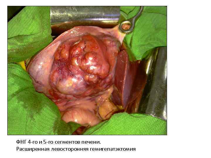 СКТ ФНГ 4 -го и 5 -го сегментов печени. Расширенная левосторонняя гемигепатэктомия 
