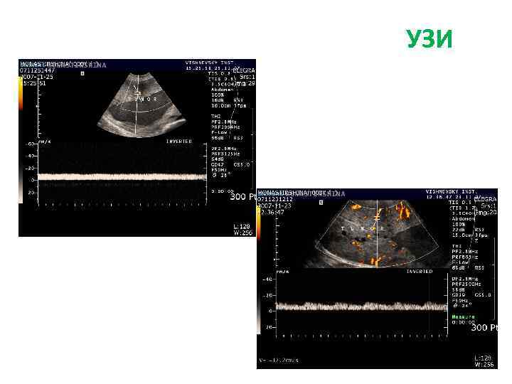 УЗИ + ДС сосудов брюшной полости УЗИ 