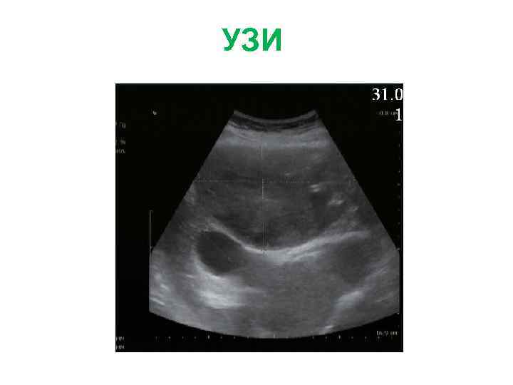 УЗИ 