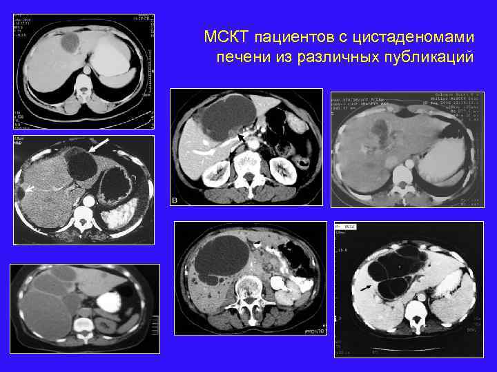 МСКТ пациентов с цистаденомами печени из различных публикаций 