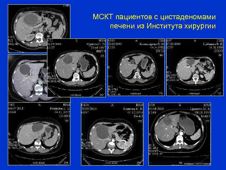 МСКТ пациентов с цистаденомами печени из Института хирургии 