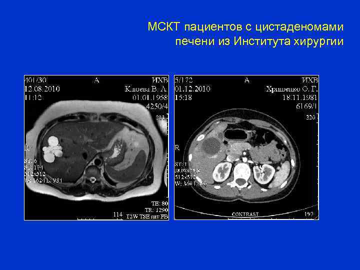 МСКТ пациентов с цистаденомами печени из Института хирургии 