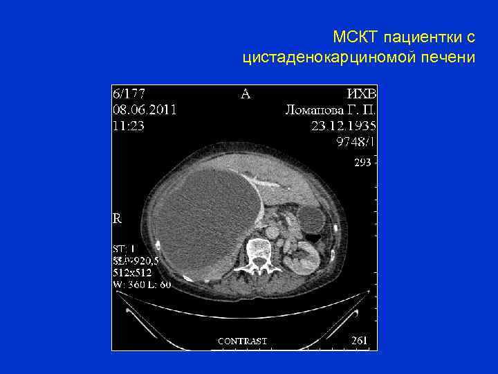 МСКТ пациентки с цистаденокарциномой печени 