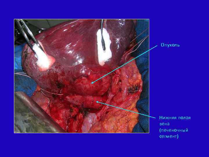 Опухоль Нижняя полая вена (печеночный сегмент) 