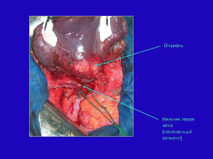 Опухоль Нижняя полая вена (печеночный сегмент) 