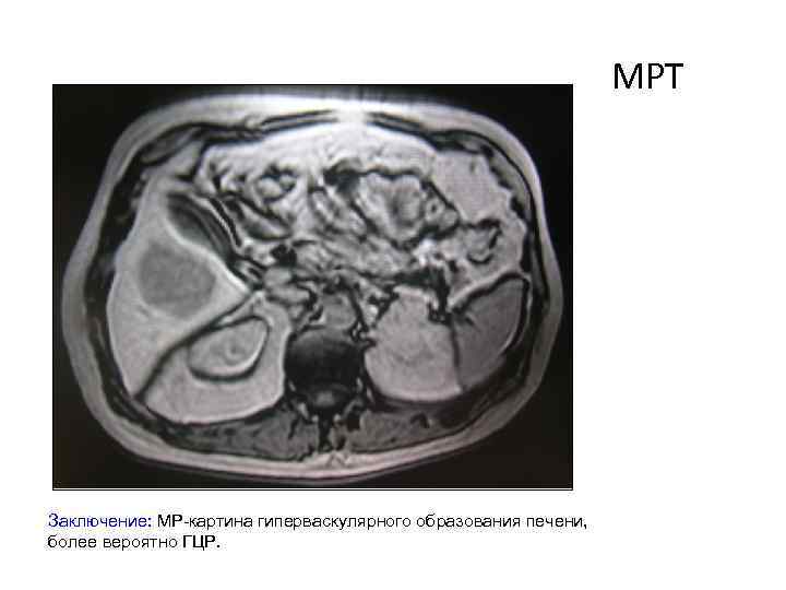 МРТ Заключение: МР-картина гиперваскулярного образования печени, более вероятно ГЦР. 