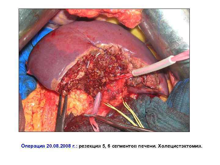 Операция 20. 08. 2008 г. : резекция 5, 6 сегментов печени. Холецистэктомия. 