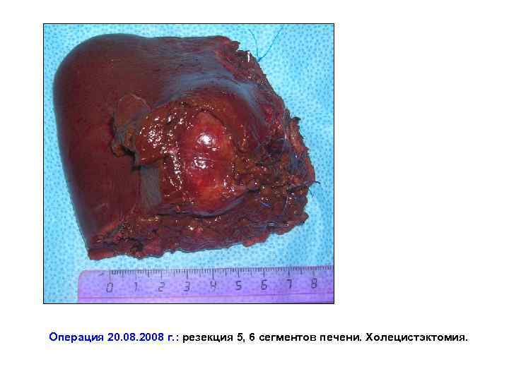 Операция 20. 08. 2008 г. : резекция 5, 6 сегментов печени. Холецистэктомия. 