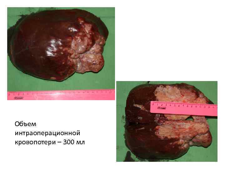 Объем интраоперационной кровопотери – 300 мл 
