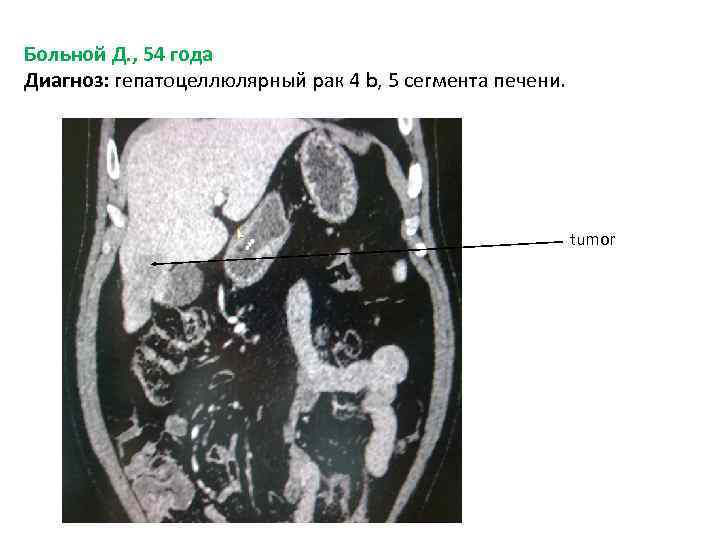 Больной Д. , 54 года Диагноз: гепатоцеллюлярный рак 4 b, 5 сегмента печени. tumor