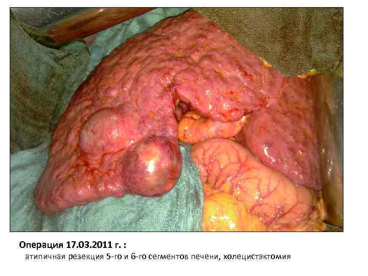 Операция 17. 03. 2011 г. : атипичная резекция 5 -го и 6 -го сегментов
