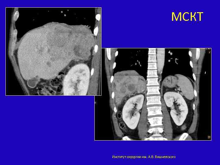 МСКТ Институт хирургии им. А. В. Вишневского 