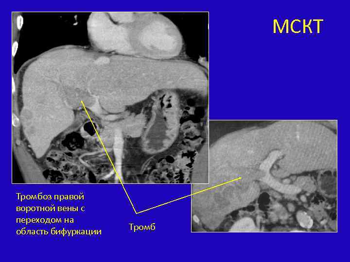 МСКТ Тромбоз правой воротной вены с переходом на область бифуркации Тромб 