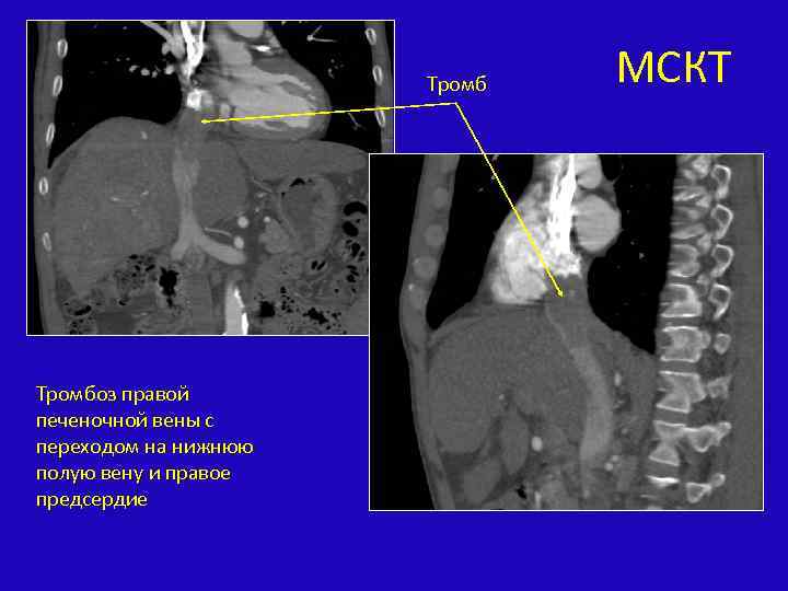Тромбоз правой печеночной вены с переходом на нижнюю полую вену и правое предсердие МСКТ